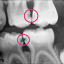 Keď zubný kaz nevidno pomôžu záhryzové snímky