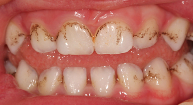 Tmavé pigmenty na zuboch – Black stains