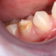Zbytočne poškodený trvalý zub, Turnerov zub